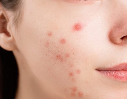 Food allergy acne on woman's face